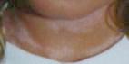 Description: Description: Description: Neck, pink spots, 7-23-96.