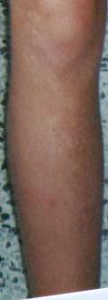 Description: Description: Description: Knee and shin, some skin is actually darker than normal, 7-97.
